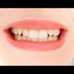 dents avant